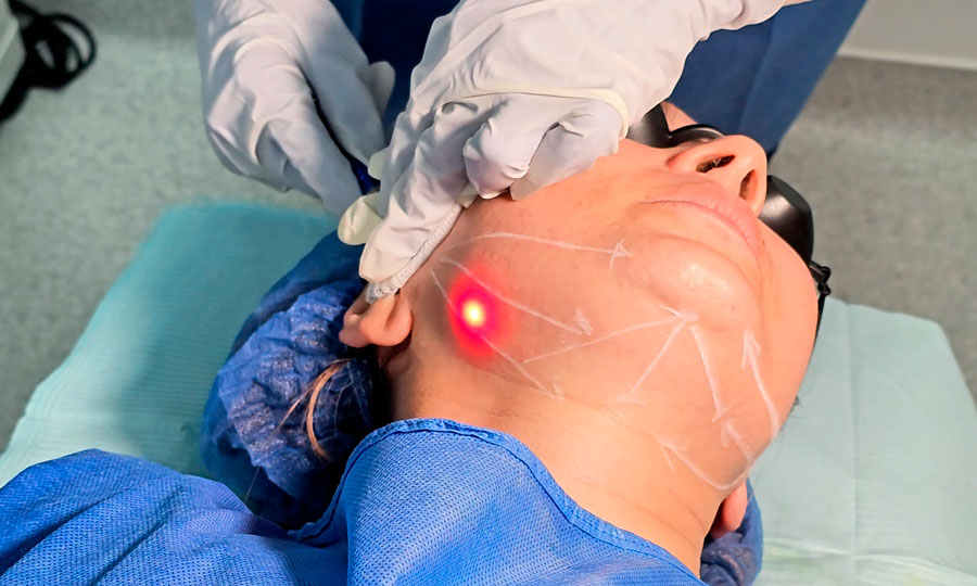 Endolifting láser - imagen 3