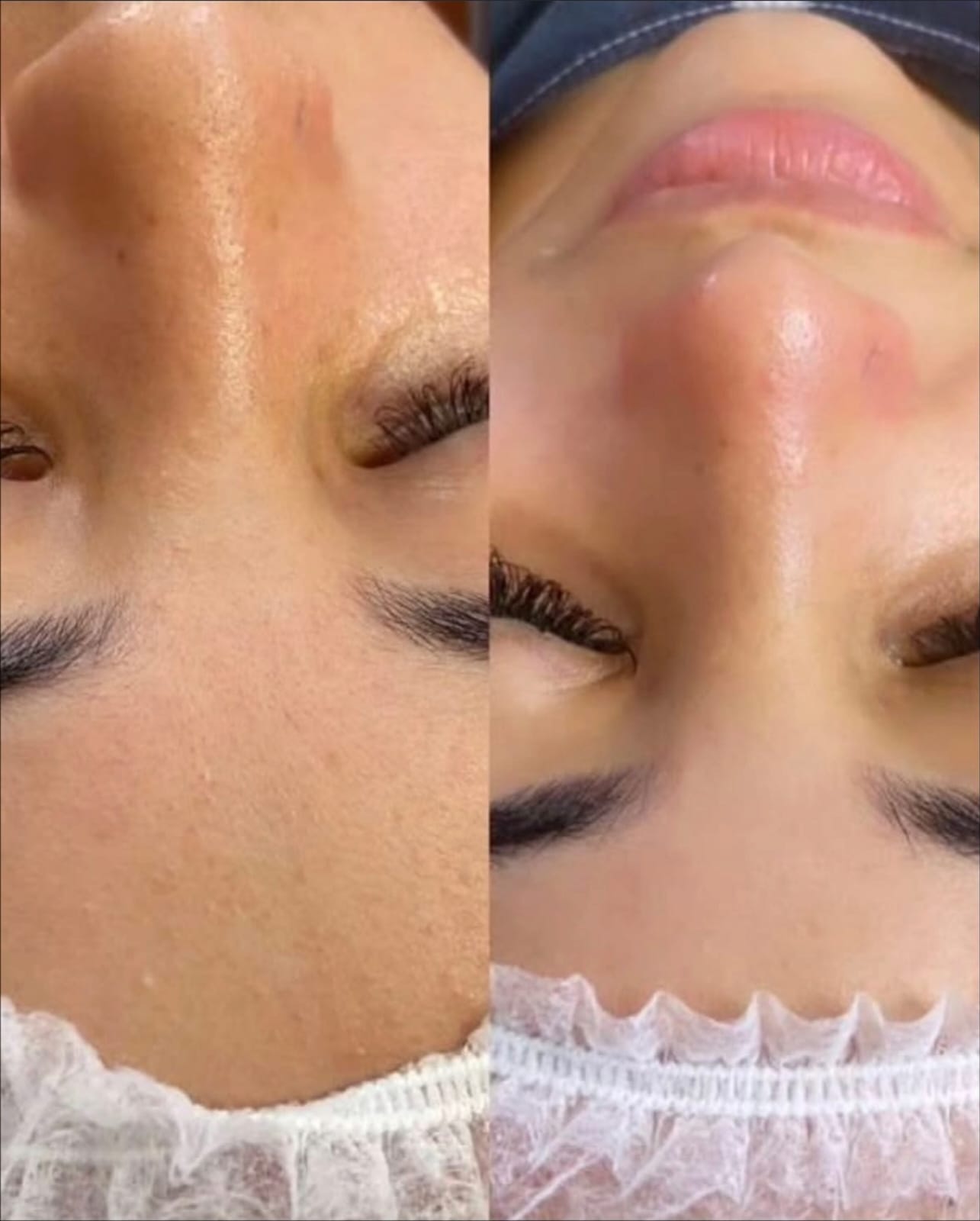 Limpieza Facial